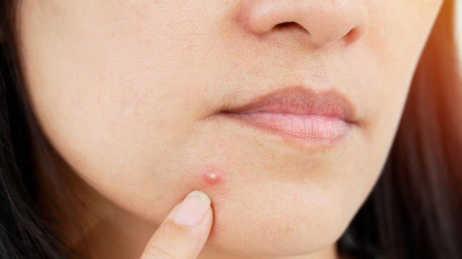 Sivilceli Ciltler İçin Doğal Maske Önerileri Nelerdir? Akneli ve Sivilceli Cilt Bakımı Nasıl Yapılmalı?