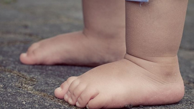 El veya ayakta aşırı büyüme ile kendisini gösteriyor: Makrodaktili hastalığı nedir, belirtileri neler?