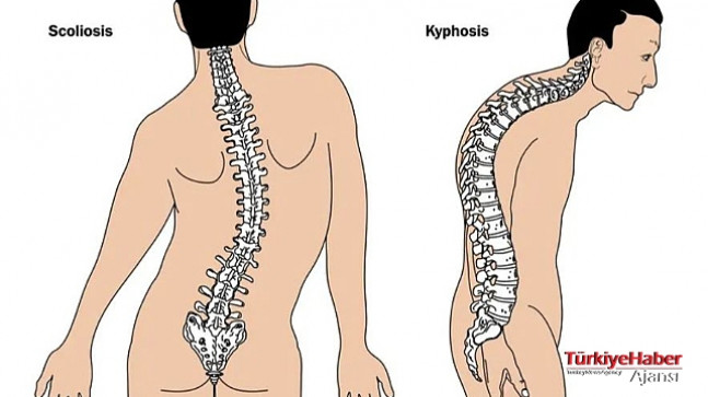 Yeni Kuşakta Gizli Tehlike Kamburluk (KİFOZ) – Sağlık