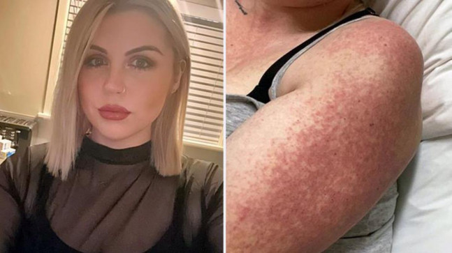 İngiltere’de ilginç olay! Vücudunda yanıklar oluşan genç kadını kullandığı ilaçlar bu hale getirmiş