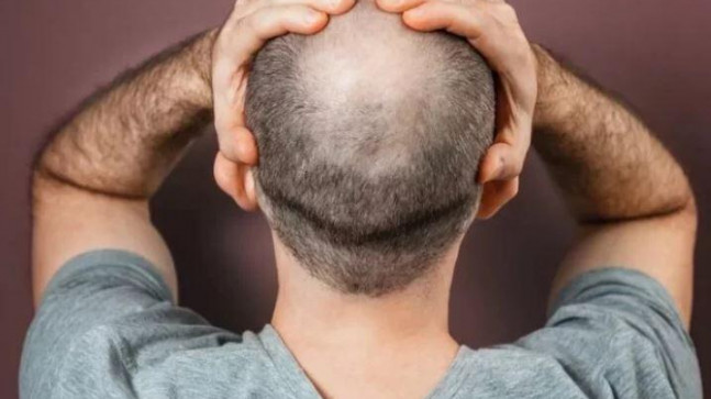 Kel olan erkekler dikkat – Sağlık Haberleri