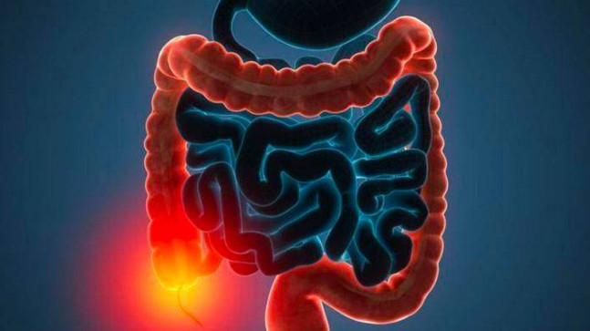 55 yaşın altındaki kişilerde görülen kolorektal kanser oranı yükseldi