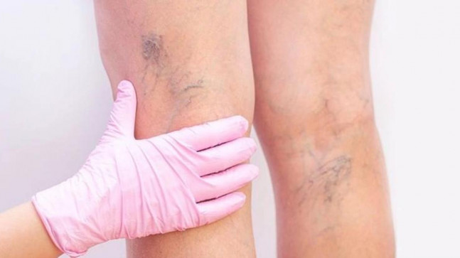 Varis tedavisi nasıl yapılır, nedir? Bacaklardaki varise ne iyi gelir? Varisler nasıl yok edilir?