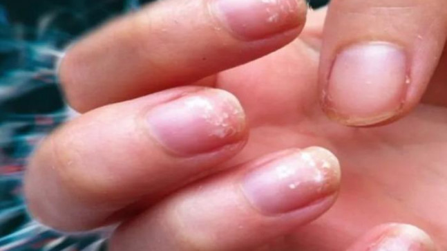 Tırnaklardaki değişime dikkat! Tehlikeli hastalığın ilk belirtisi
