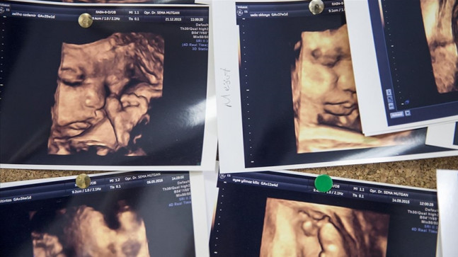 Çoğul gebelik oranları Kovid-19 sonrası dünya genelinde artışa geçti